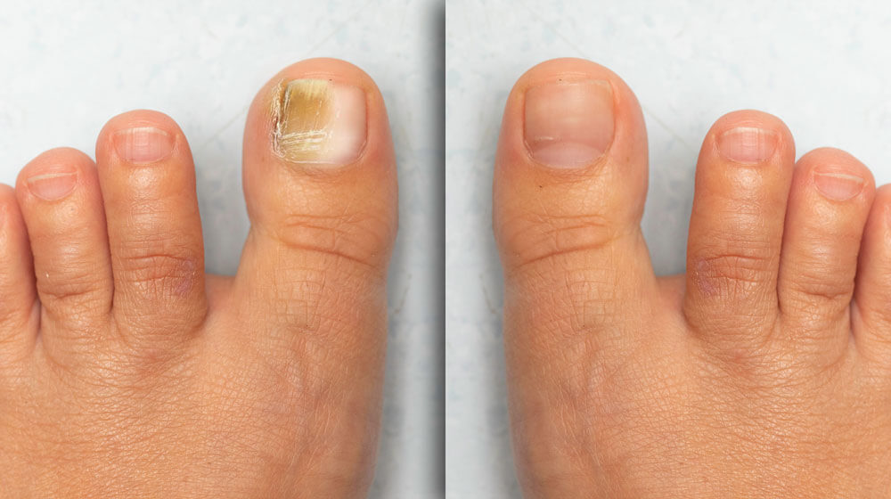 Nail Conditions | NY | Hudson Dermatology