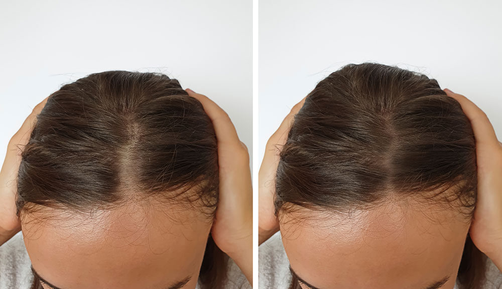 Alopecia (Hair Loss) | NY | Hudson Dermatology