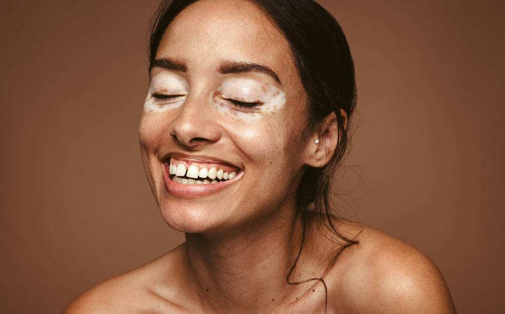 Woman smiling with vitiligo