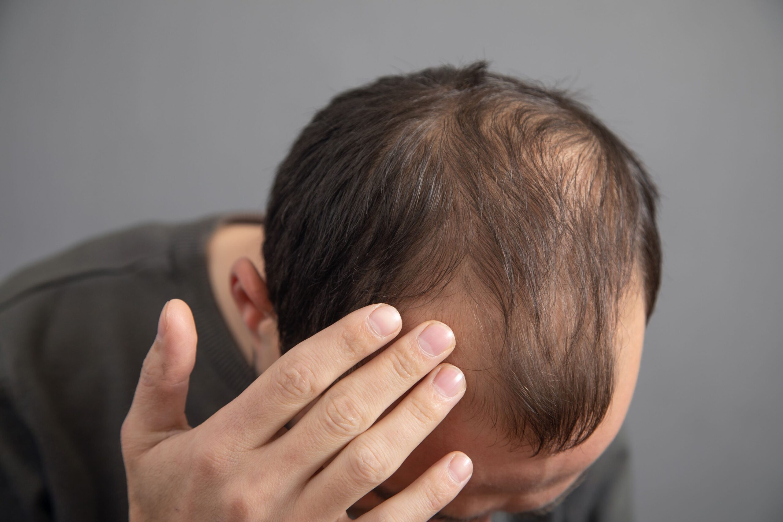 Man showing hair loss